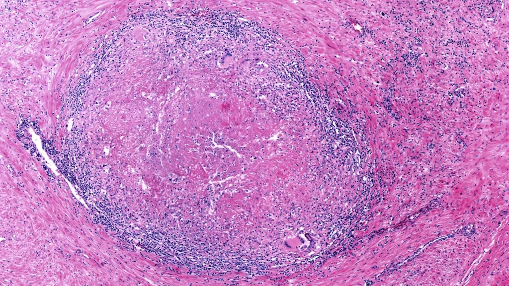 Churg-Strauss syndrome.